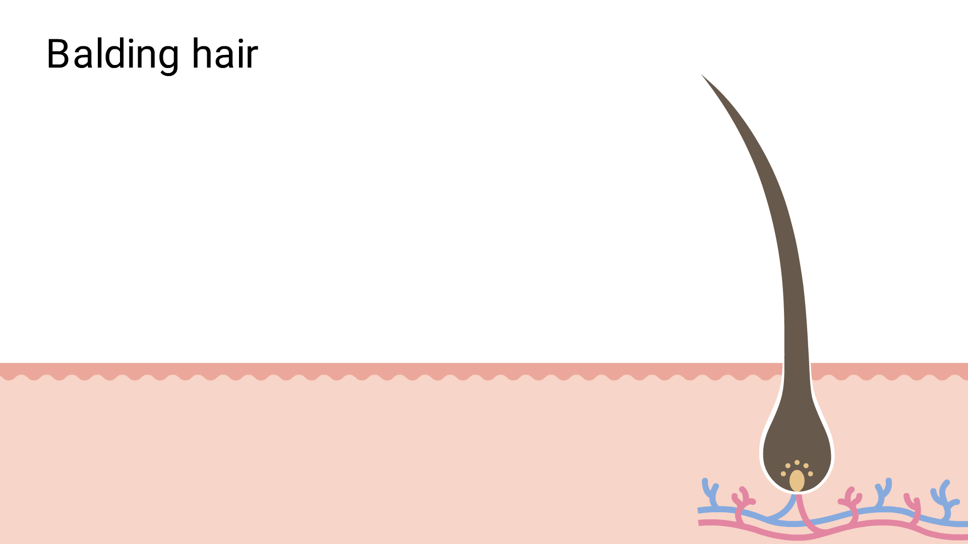 Hair follicles shrinking over time to produce progressively shorter and finer hairs.